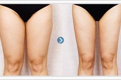 Hô biến chân to như 'cột đình' thành thon gọn với 6 bài tập đơn giản