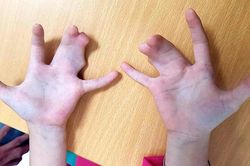 Gia đình nhiều thế hệ ở Tiền Giang mắc hội chứng càng tôm hùm