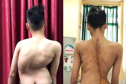 Ca phẫu thuật giúp thiếu niên 17 tuổi cao thêm 8cm sau 1 đêm