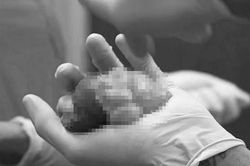 Chàng trai mọc u ở vùng kín như tinh hoàn thứ ba