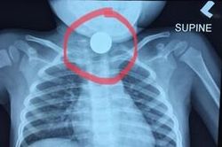 Con nhỏ nuốt phải đồng xu, bà mẹ đưa đi cấp cứu nhưng bệnh viện có phản ứng gây bức xúc