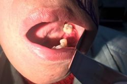 Thấy sưng đau lợi tưởng chỉ sâu răng thông thường, không ngờ mắc ung thư hiếm gặp