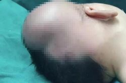 Bé sơ sinh bị tụ máu não vì mẹ đẻ rơi con xuống đất
