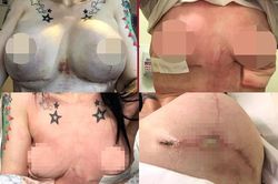 Ra nước ngoài nâng ngực, cô gái trẻ phải cắt bỏ 2 bên vú
