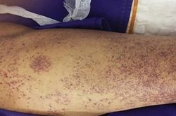 Người đàn ông nguy kịch do nhiễm liên cầu khuẩn lợn