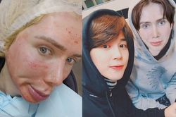Sau nhiều lần dao kéo, chàng trai lại tiêm trắng để giống Jimin hơn