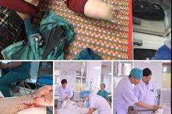 Báo động đỏ toàn bệnh viện, xuyên đêm nối cánh tay đứt lìa cho người phụ nữ