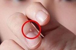 Ngón tay người đàn ông 'chứa' đầy tế bào ung thư, thủ phạm là hành động nhỏ bạn thường làm