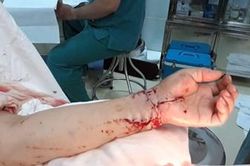 Nối thành công bàn tay bị đứt lìa ướp đá