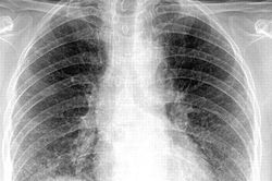 WHO nói gì về mức độ nguy hiểm của virus corona mới?
