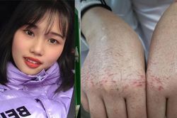 Nữ y tá với đôi tay nứt nẻ tuôn máu vẫn quyết tâm chiến đấu chống virus corona