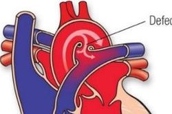 Những điều cần biết về còn ống động mạch