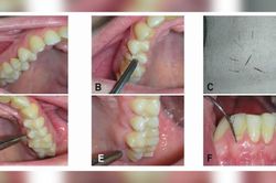 Mắc bệnh lạ, người phụ nữ mọc lông ở… lợi