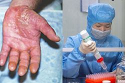 Xót xa đôi bàn tay ửng đỏ, sưng tấy của các bác sĩ Vũ Hán làm việc suốt hơn 12 tiếng mỗi ngày