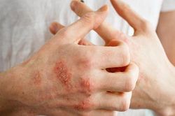 Ngăn ngừa bệnh chàm tái phát vào mùa lạnh, thuốc gì?