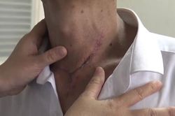 Người đàn ông suýt chết vì hóc xương gà