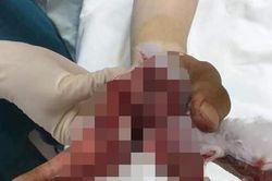 Dập nát bàn tay, cắt 3 ngón vì vừa sạc pin ĐTDD vừa dùng