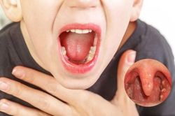 Trời lạnh, coi chừng viêm họng phát tác