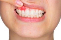 Cách phòng ngừa viêm lợi