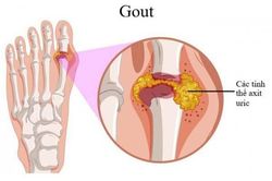 Tại sao nói Axit uric tăng cao gây bệnh gút là không thể xem thường?