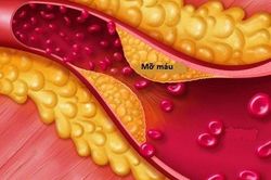 Người bị rối loạn mỡ máu nên ăn gì?