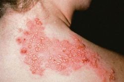 Bệnh giời leo có lây không?