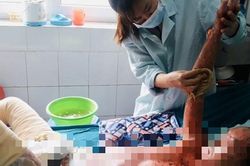 Bình ga mini phát nổ, cháu bé ở Hà Tĩnh bị bỏng 71% mà không có tiền chữa trị