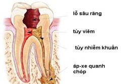 Phòng viêm nhiễm hàm mặt