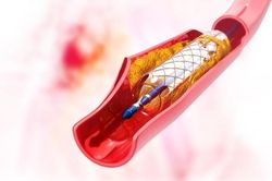 Thông tin không thể bỏ qua trước khi đặt stent mạch vành