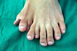 Kỳ lạ: Chàng trai có đến…14 ngón chân