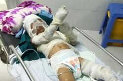 Chưa thể khẳng định thời gian hồi phục của bé trai 6 tuổi bị dì tẩm xăng đốt