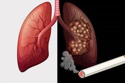 90% bệnh nhân ung thư phổi do hút thuốc lá