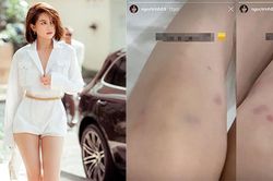 Ngắm chân thon 'cực phẩm' của Ngọc Trinh trước khi lộ ảnh thâm tím đầu gối