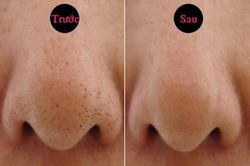 Sạch mụn đầu đen chỉ với bí quyết đơn giản