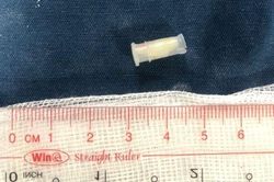 Bị sặc trong lúc chơi, cháu bé 3 tuổi nguy kịch vì nuốt chiếc còi nhựa vào phế quản