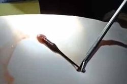Bé trai 3 tuổi bị đỉa chui vào mũi sống ký sinh