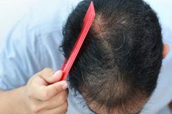 Rụng tóc do đái tháo đường: Nguyên nhân và cách khắc phục