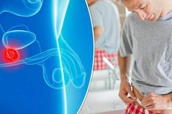 Làm gì để phát hiện ung thư tuyến tiền liệt sớm?