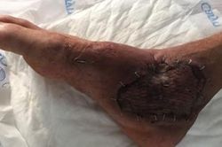 Suýt mất chân do tự điều trị thuốc nam tại nhà