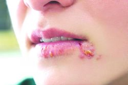 Bệnh mụn rộp có lây lan?