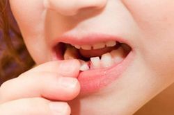 Những 'thủ phạm' khiến răng trẻ mọc lệch: Mẹ cần biết để điều chỉnh kịp thời