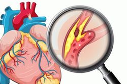 Chớ chủ quan với bệnh xơ vữa động mạch vành