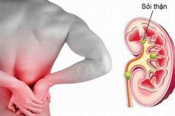 Chớ coi thường sỏi thận - tiết niệu