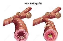 Chăm sóc bé mắc bệnh hen đúng cách, giảm biến chứng
