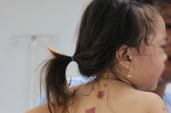 Nguy cơ mắc viêm da dị ứng cấp tính ở trẻ nhỏ do dùng thuốc tùy tiện