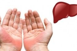 Xòe lòng bàn tay và nắm chặt, nếu thấy có dấu hiệu này hãy đi khám càng nhanh càng tốt