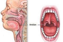 Đừng để viêm amidan trở thành áp-xe