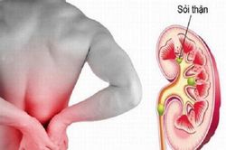 5 cách ngừa suy thận khi bị sỏi