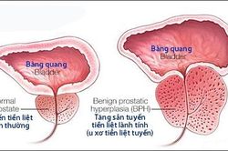 Các bệnh thường gặp ở tuyến tiền liệt