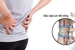 Những tiến bộ trong điều trị xẹp đốt sống lưng do loãng xương